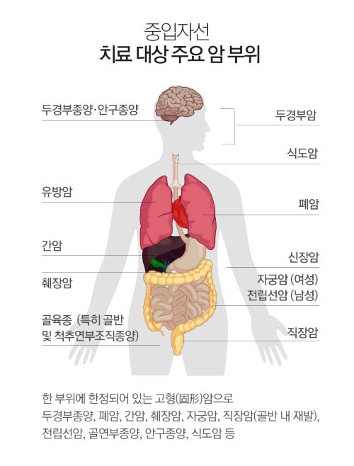 중입자 암치료 대상부위