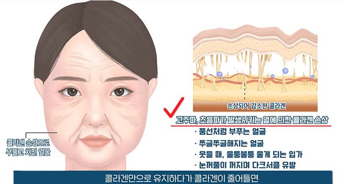 레이저 리프팅 부작용