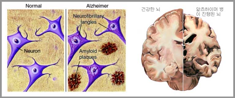 알츠하이머 병 뇌변화