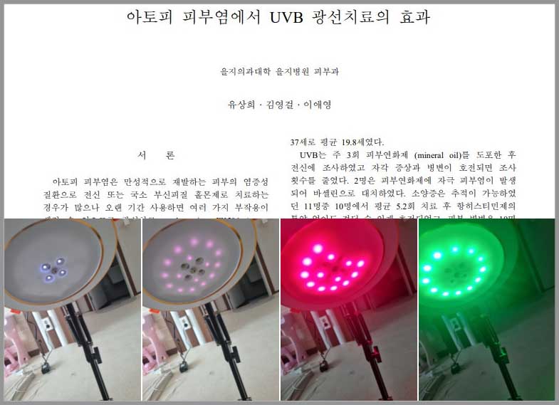 성인아토피 피부염 UVB 광선치료 효과 논문