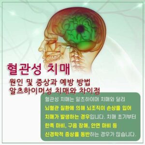 혈관성 치매 썸네일