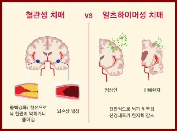 혈관성 치매 와 알츠하이머성 치매