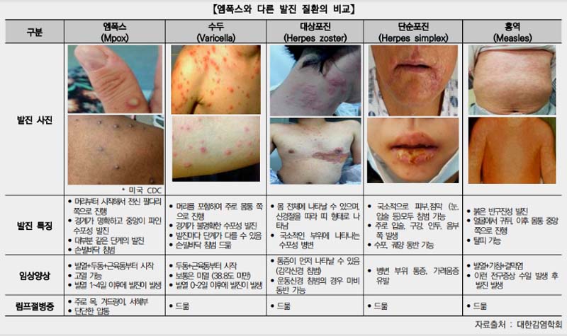 엠폭스 원숭이두창 비교